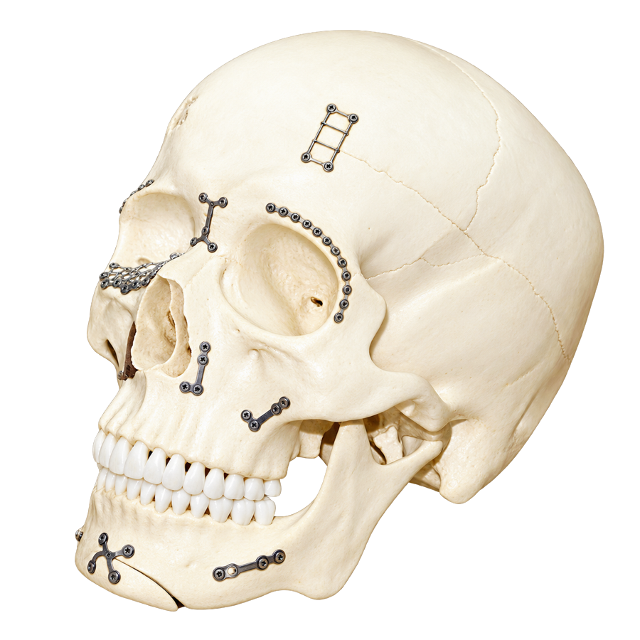 Skull model fitted with Osteo-Fit plates and screws